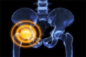 Chiropractic for Hip Pain