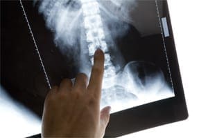 Spondylolisthesis Causes and Treatment Options